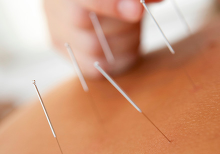 Acupuntura en Bogotá