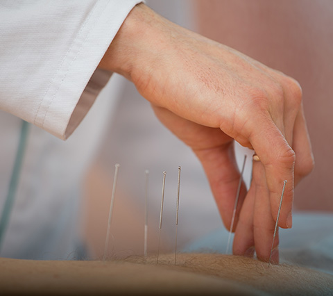 Médico acupunturista en Bogotá colocando agujas a paciente